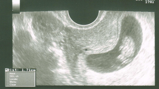 Seconde échographie, 20mm et un grand soulagement