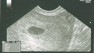 Première écho, mais beaucoup de stress