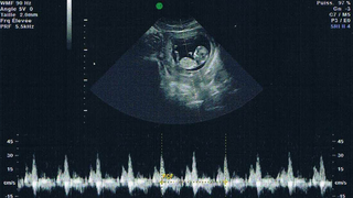 Echographie du premier trimestre